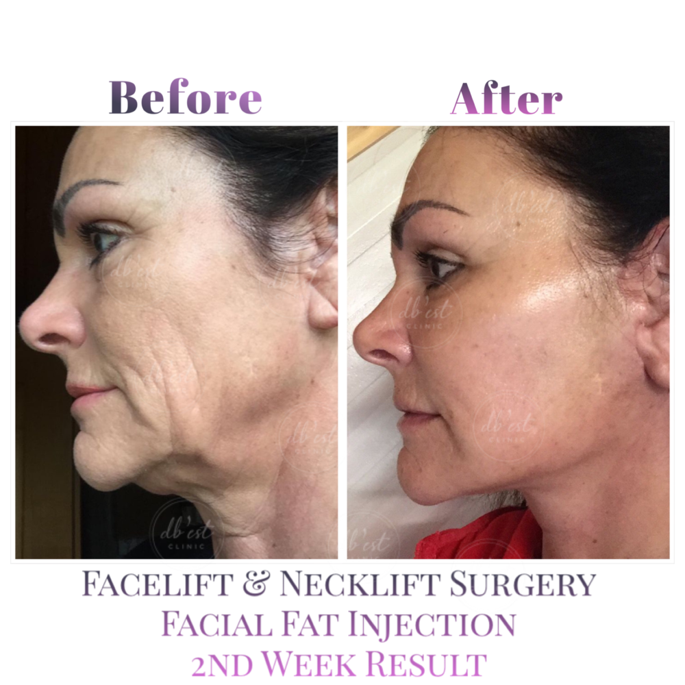 Before and After Result